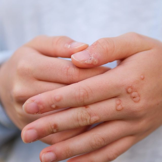 Bradavice | foto: Profimedia